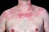 Dermatographic urticaria
