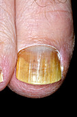 Fungal nail infection after treatment