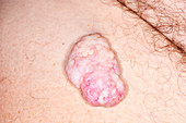 Pleomorphic lipoma