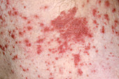 Bullous pemphigoid