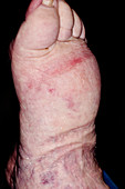 Lymphoedema following bandaging