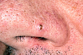 Dilated pore