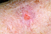 Basal-cell carcinoma skin cancer