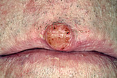 Squamous-cell carcinoma skin cancer