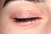 Eczema around the eye
