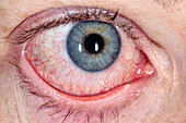 Episcleritis