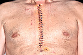 Heart bypass surgery scar