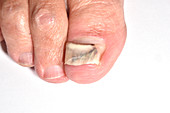 Damaged toe nail