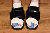 Feet after bunion surgery