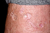 Cigarette burn scars in self-harm