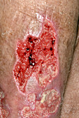 Varicose ulcer