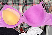Padded bra in asymmetric breasts