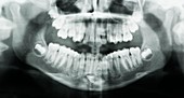 Supernumerary tooth,X-ray