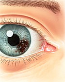 Melanoma of the iris,illustration