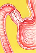 Cancer of the stomach,illustration
