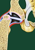 Congenital hip dislocation,illustration