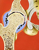 Hip joint inflammation,illustration