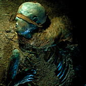 The mummified head and torso of Windeby Girl