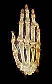 Mummified hand,X-ray