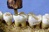 Neolithic tooth drilling procedure