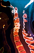 Arthritis of the spine,CT scan