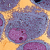 Leukaemia cells,TEM