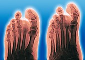Amputated toe,X-ray