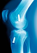 Anterior cruciate ligament repair,X-ray