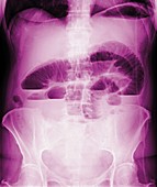 Occluded intestine,X-ray