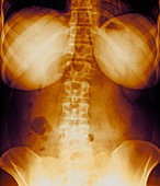 Female torso,X-ray