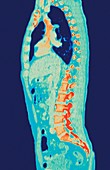 Normal torso,MRI scan