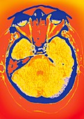 Normal brain,CT scan