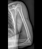 Normal shoulder and elbow joints,X-ray