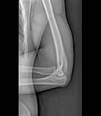 Normal elbow joint,X-ray