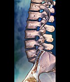 Normal spine,CT scan