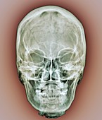 Normal skull,X-ray