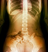 Normal abdomen,X-ray