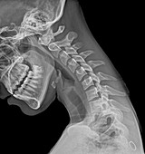 Normal flexed neck,X-ray
