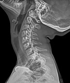 Normal extended neck,X-ray