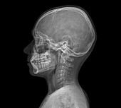 Normal child's head,X-ray