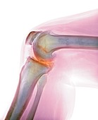 Arthritis of the knee,X-ray