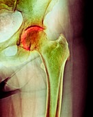 Arthritis of the hip,X-ray