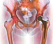 Loosened hip replacement,X-ray