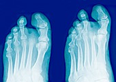 Amputated toe,X-rays