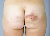 Bruised buttock