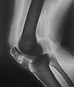 Broken knee,X-ray