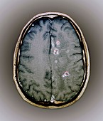 Tapeworm cysts in the brain,MRI scan