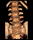 Degenerative disc disease,3D CT scan