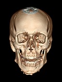 Normal skull,3D CT scan