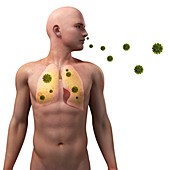 Viral lung infection,conceptual artwork
